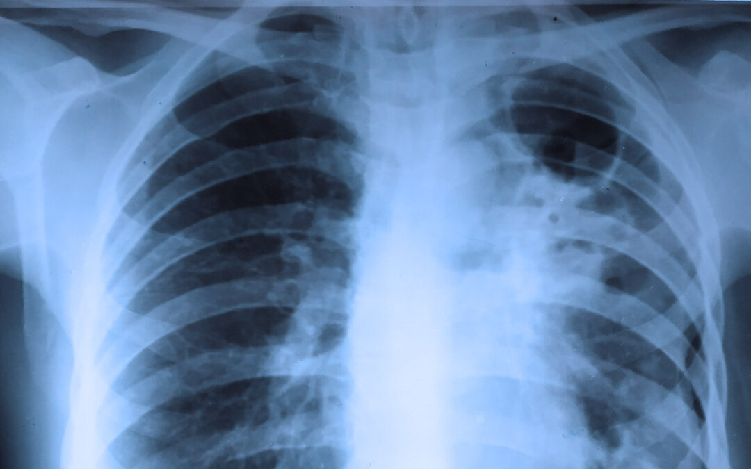 The psychological meaning of tuberculosis