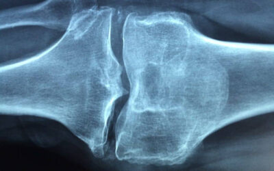 Osteoporosis – The desire to be cared for